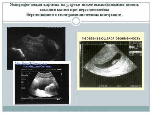 К сожалению, в большинстве случаев женщина не знает о том, что ее ребенок уже погиб, поскольку не развивающаяся беременность на ранних сроках не имеет ярких симптомов, которые характерны для выкидыша