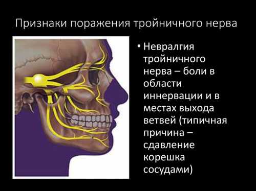 Невропатия