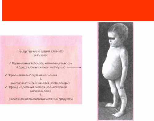 Синдром мальабсорбции у детей, глюкозо галактозная мальабсорбция