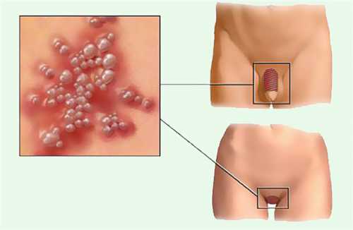 Герпес у женщин: симптомы, причины, это