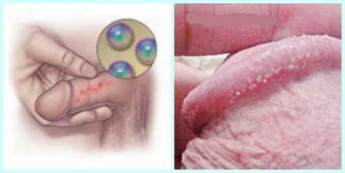 Ситуация усугубляется, если у матери на половых органах есть свежие высыпания
