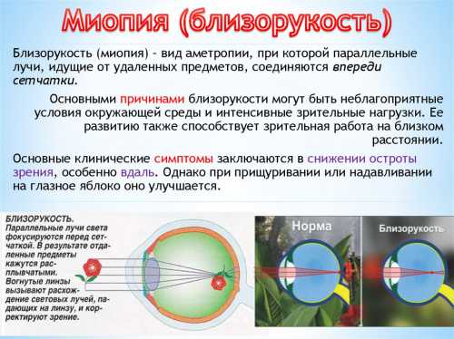 Миопия близорукость