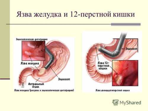 Отварить очищенный картофель, не добавляя соли, и пить отвар раза в день до еды