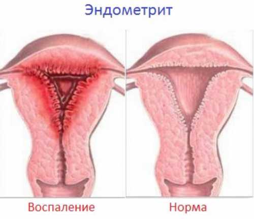 Симптомы хронического поражения эндометрия таковы