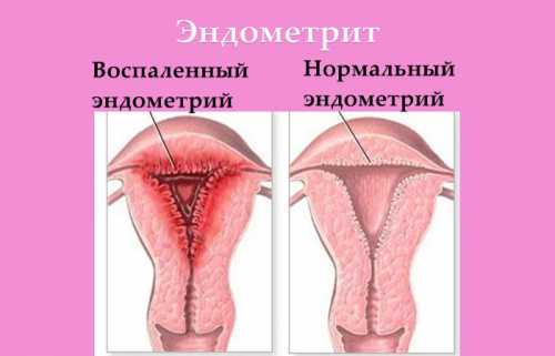 Данные анамнеза что то было простуда при выскабливании, бурный секс в период менструации и тд