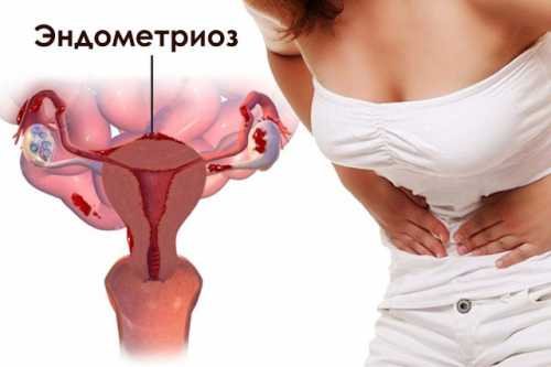 Беременность при эндометриозе матки