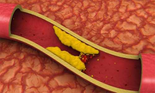 Вот как очистить кровеносные сосуды от холестерина всего за 40 дней