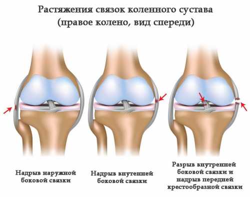 При разрыве внутренней боковой связки возникает ярко выраженный отек, при пальпации ноги пациент чувствует болезненность в районе большеберцовой кости, при движении, попытке отклонить голень кнаружи боль усиливается