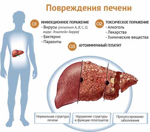 Симптомы болезни печени Заболевания печени