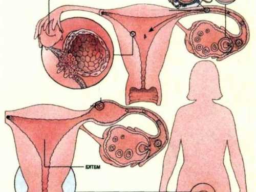 Самый опасный случай разрыв маточной трубы